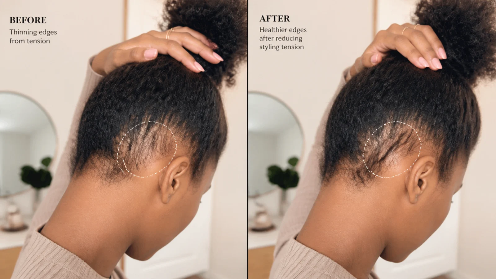 Thinning edges along a hairline compared with healthy baby hairs after reducing styling tension
